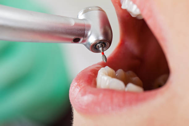 Best Emergency Wisdom Tooth Extraction in Reidland, KY